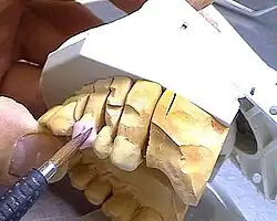 Anfertigung einer Keramikverblendung auf einer Brücke. Die keramischen Massen werden in breiiger Konsistenz angerührt und mit einem Pinsel aufgetragen.