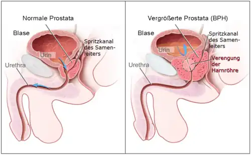 Schaubild, das normale und vergrößerte Prostata im Vergleich zeigt
