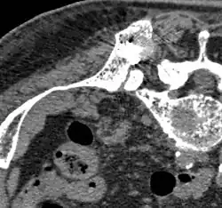 Nach der RFA: Die Verteilung des Knochenzementes in dem nach der Ablation entstandenen Hohlraum ist zu erkennen.