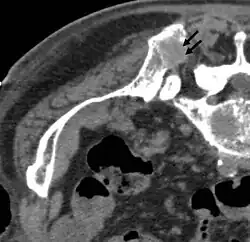 Vor der RFA: Hinterer oberer Darmbeindorn (Spina iliaca posterior superior) mit osteolytischer Metastase (ca. 2 cm im Durchmesser, siehe Pfeile)