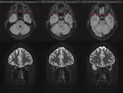 MRT des Sehnervs (axiale und koronale Schnittbilder)