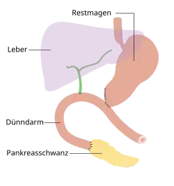 Endzustand nach Whipple-Operation