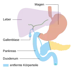 Pylorus-erhaltende Teilresektion