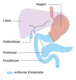 Totale Pankreas­resektion