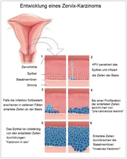 Entwicklung eines Zervixkarzinoms nach Penetration von HPV. Stadium 6: Penetration des Karzinoms in benachbartes Gewebe.