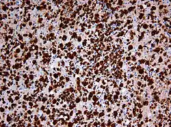 Nachweis zahlreicher Makrophagen (braun gefärbt) in der immunhistochemischen Färbung für CD68. Chromogen Diaminobenzidin, Gegenfärbung mit Hämatoxylin. Vergrößerung 200x.