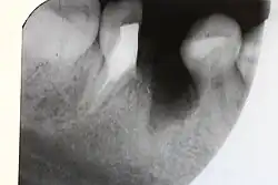 Röntgenbild von 46 nach der Hemisektion (mesiale Wurzel entfernt) – die Wurzelfüllung an der verbliebenen distalen Wurzel 46 ist zu erkennen