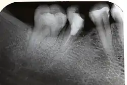 Röntgenbild des gleichen Zahnes nach 16 Jahren.