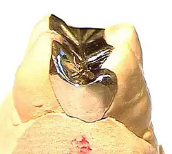 Goldfüllung (Goldinlay)