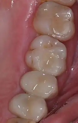 Darstellung von zwei Inlays und zwei Kronen aus Lithium-Disilikat in situ.