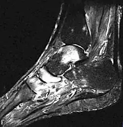Knochenmarködem (hell) in Sprungbein, Kahnbein und Keilbein