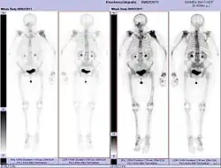 Ganzkörperknochenszintigramm mit 99mTc-HDP der Patientin mit der Oberarmfraktur aufgrund einer Brustkrebsmetastase