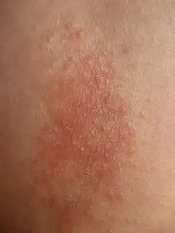 Lichen simplex chronicus am Unterarm