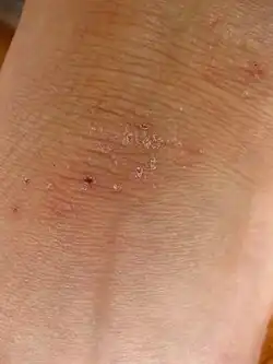 Lichen simplex chronicus am Knöchel