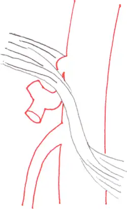 Schematische Darstellung: links der anatomische Normalbefund, das Ligamentum arcuatum medianum liegt oberhalb des Abganges der Arteria coeliaca; rechts gut zu erkennen, wie das Ligamentum das Gefäß einschnürt.