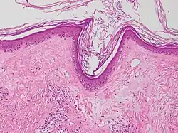 Lichen sclerosus mit follikulärer Hyperkeratose