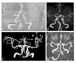 Die Time-of-Flight-Magnetresonanzangiographien von vier Morbus-Fabry-Patienten zeigen erweiterte (ekstatische) Blutgefäße (Dolichoektasien der vertebrobasilären Zirkulation).