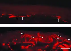 Fluoreszenzmikroskopaufnahmen eines Gefrierschnittes der Haut eines Morbus-Fabry-Patienten. Auffällig ist der Mangel an intraepidermalen Nervenfasern und das Vorhandensein von Fasern, die zum subepidermalen Nervenplexus gehören (Pfeile). Die untere Hautprobe stammt dagegen vom Rücken des Patienten. Hier ist die dichte Innervation der Epidermis (Pfeile) auffällig.