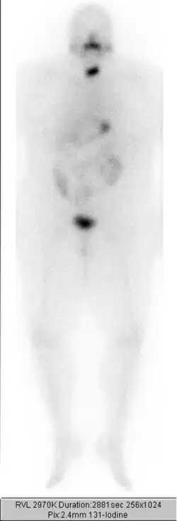 …nach 2. ablativer Radiojodtherapie mit 3,7 GBq Jod-131. Geringe Speicherung in der Restschilddrüse.