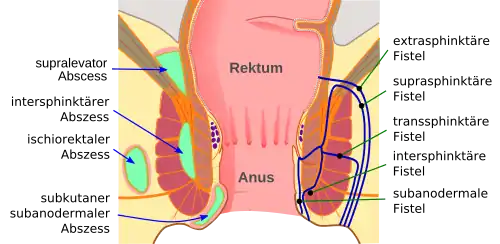 Grafische Darstellung der unterschiedlichen Analabszess- (links) und Analfisteltypen (rechts)