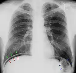 Pneumoperitoneum im Thoraxröntgenbild. Die freie „Luft“ ist zwischen dem Oberrand der Leber (rote Pfeile) und dem Zwerchfell (grüne Pfeile) zu erkennen. Die blauen Pfeile zeigen auf den gasgefüllten Dickdarm (normal).