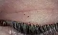 Filzlausbefall auf Augenwimpern