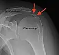 Röntgenbild bei Tendinosis calcarea der Schulter (Kalzifikationshase)