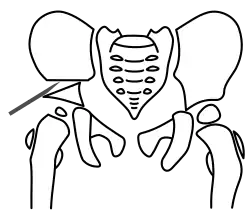 Schritt 2 – Herunterklappen des Pfannenfragmentes zur Seite und nach vorne