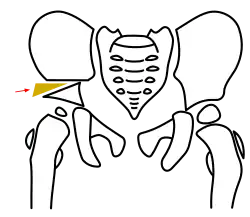 Schritt 3 – Interposition des Knochenkeiles