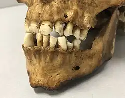 Gebiss von Theo dem Pfeifenraucher mit seinen charakteristischen Zahnlücken. Naturhistorisches Museum Basel