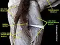 Der N. radialis schlingt sich zwischen dem Caput longum und dem Caput laterale des Triceps brachii hindurch.