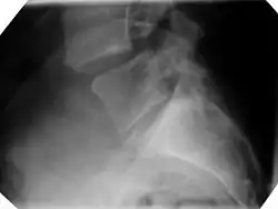 Bild 1: Gleiten zwischen Lendenwirbeln 4/5, im seitlichen Röntgenbild.