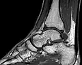 MRT des Sprunggelenks in T1-Wichtung