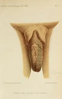 Hypertrophie der inneren Schamlippen bei einer Frau der Khoisan, in gespreiztem Zustand (links) und aufrecht stehend (rechts)