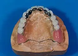 Oberkiefer-Hybridprothese auf dem Arbeitsmodell von okklusal gesehen. Beachte: Der harte Gaumen ist nicht mit einer Kunststoffplatte bedeckt.