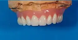 Oberkiefer-Hybridprothese auf dem Arbeitsmodell von vestibulär gesehen.