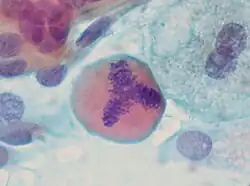 Tripolare Mitose in einem Ausstrichpräparat (Bronchiallavage)