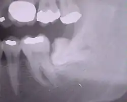 Weisheitszahn 38; retiniert und verlagert; mesiale Kippung um fast 90°