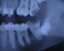 Weisheitszahn 38 angelegt – fast noch keine Wurzel ausgebildet; mesial gekippt.